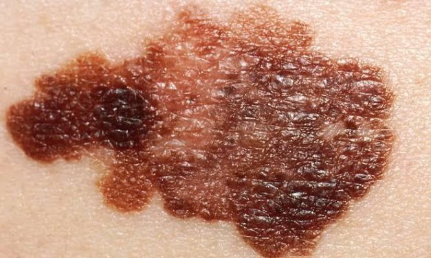 Llama IMSS a detectar a tiempo Melanoma.