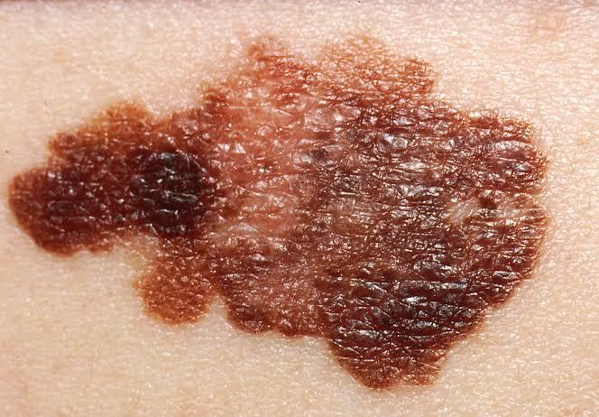 Llama IMSS a detectar a tiempo Melanoma.