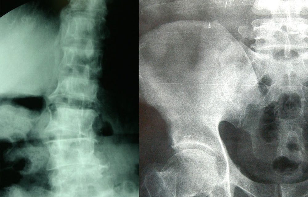 Mujeres mayores de 50 años sufren fracturas por osteoporosis.