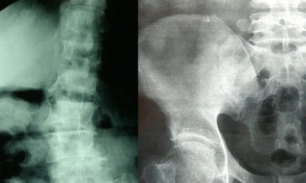 Mujeres mayores de 50 años sufren fracturas por osteoporosis.
