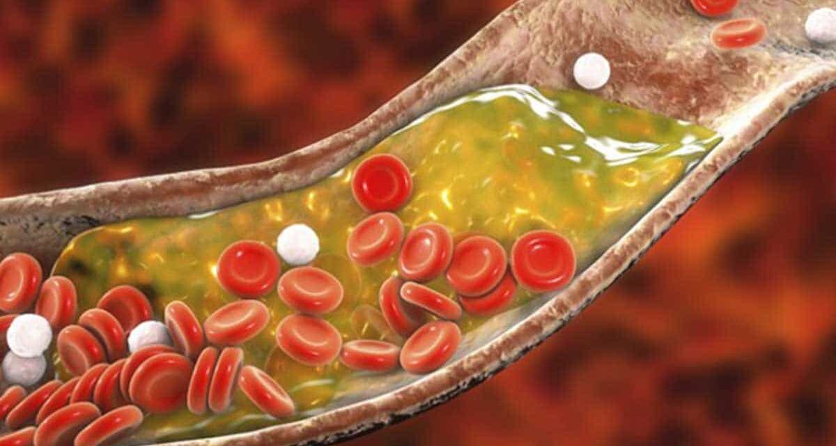 IMSS SLP recomienda alimentación baja en grasas saturadas para evitar aumento de colesterol y triglicéridos en sangre